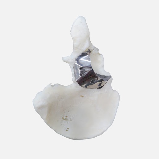 3D Printing Orthopaedic Implant