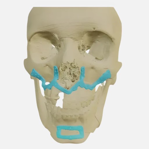 Patient-Specific OMF Implant