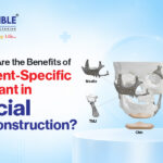 What Are the Benefits of Patient-Specific Implants in Facial Reconstruction