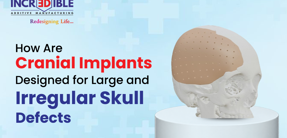 How Are Cranial Implants Designed for Large and Irregular Skull Defects