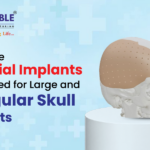 How Are Cranial Implants Designed for Large and Irregular Skull Defects