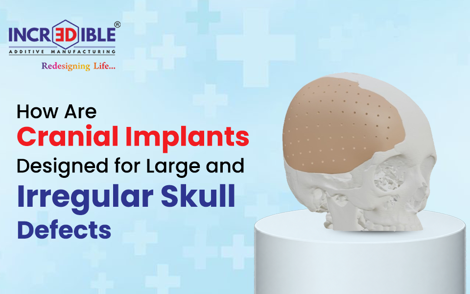 How Are Cranial Implants Designed for Large and Irregular Skull Defects