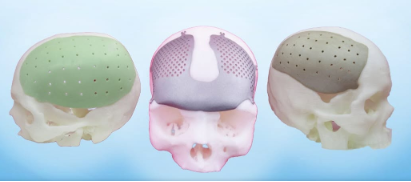 Materials Can Be Used for Cranial Implants
